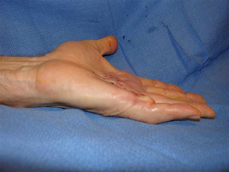 Dupuytren's Contracture after treatment