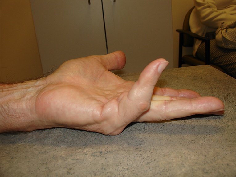 Dupuytren's Contracture before treatment