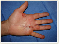Before - Palm