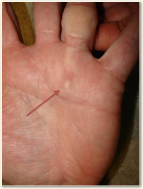 Dupuytrens Contracture with Nodules Picture