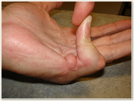 Dupuytrens Contracture Cord Contracture Picture
