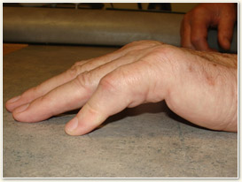 Dupuytrens Contracture Tabletop Test Picture